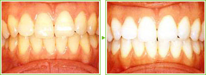 ホワイトニングとは
