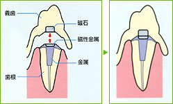 磁石を使った入れ歯（マグフィット）