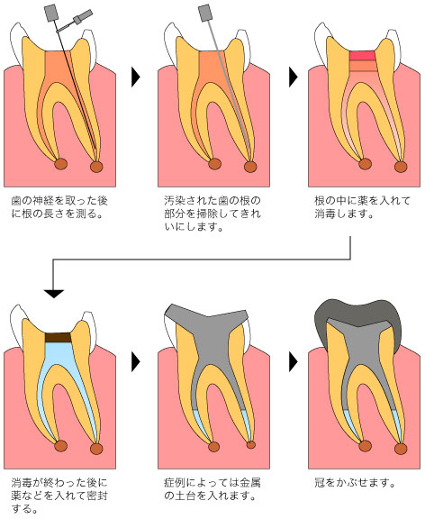 根尖病巣の治療例